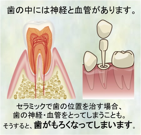 神経をとった歯の寿命は短い！？ 　～予防すれば大丈夫！～