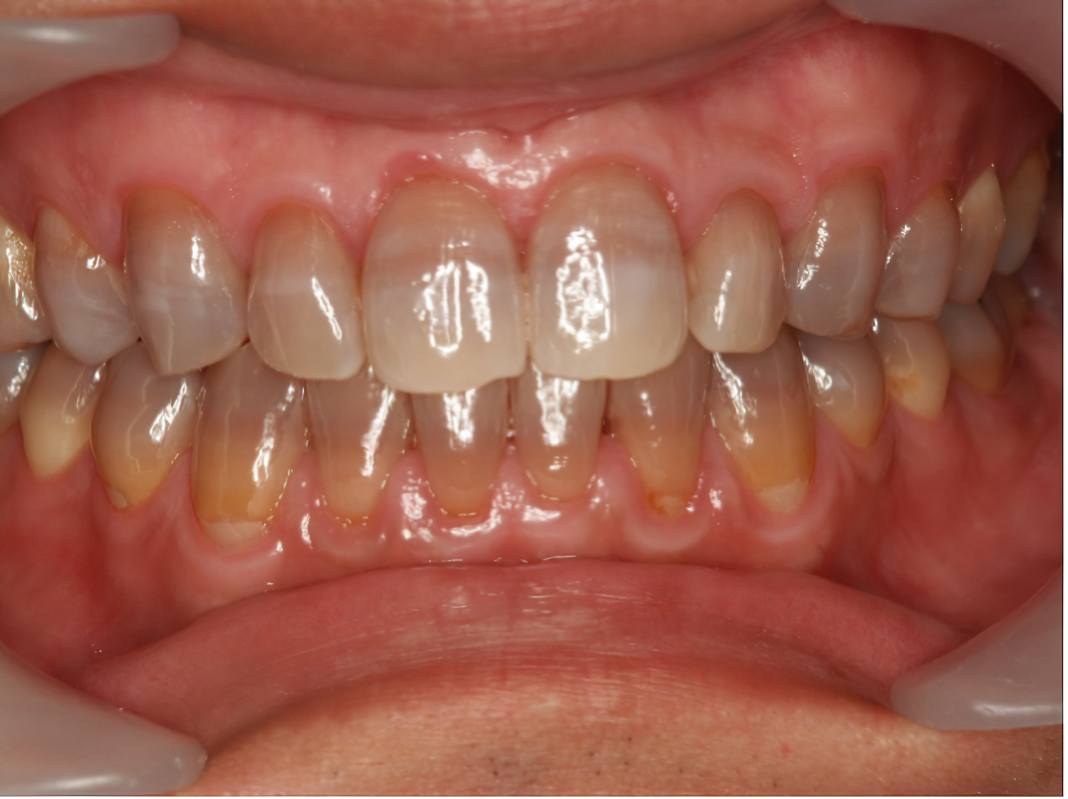 テトラサイクリン歯もホワイトニングで改善できることがあります！