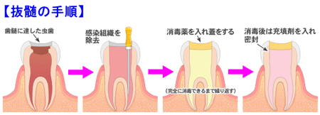 歯の神経はできるだけ抜かない方が良い?!