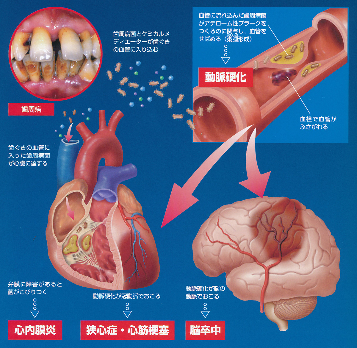 心臓が悪いなら歯医者に定期通院しよう！　　～歯と心臓の関係～