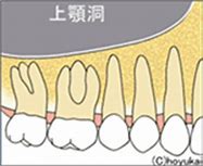 蓄膿の原因の１つに「歯」？歯が原因で鼻づまり？